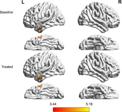 Brain Structural and Functional Reorganization in Tinnitus Patients Without Hearing Loss After Sound Therapy: A Preliminary Longitudinal Study